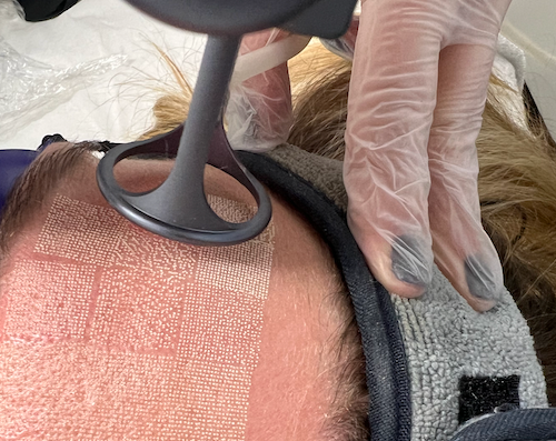 CO₂ Laser Treatment in Progress