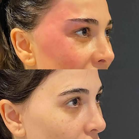 Crow's Feet & Scarring Improvement